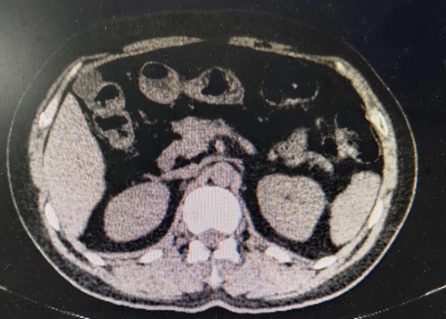 新辅助化疗肺癌病理完全缓解,宫颈癌术后辅助化疗