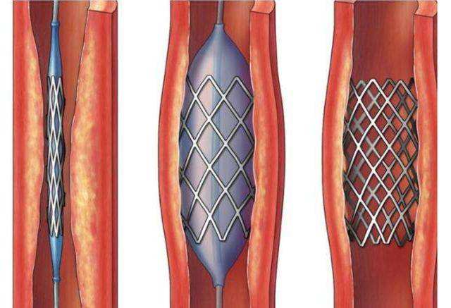 心肌缺血心跳加速是什么原因,老年人心肌缺血是什么原因造成的