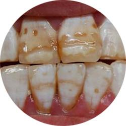 牙齿发黄如何变白有什么方法,牙齿发黄怎么办教你一招变白