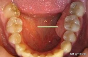 牙槽骨肿了不疼怎么回事,牙槽骨突出面部不舒服怎么办
