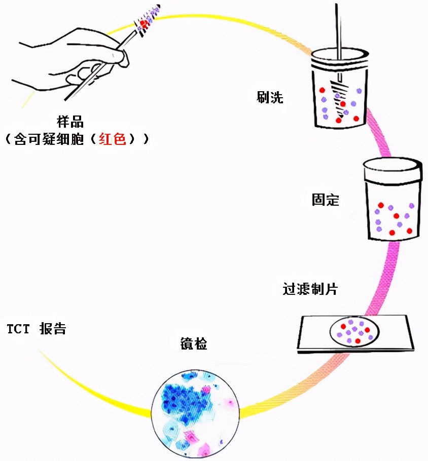 TCT、阴道镜、CIN、锥切(leep)都是什么意思?