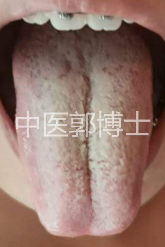 月经淋漓不尽吃中药止血后量变多,例假淋漓不尽隔几天还流一股鲜血