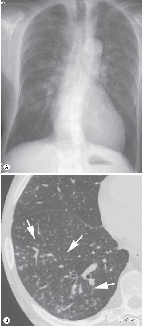 肺部感染并发症,老人新冠引起肺部并发症