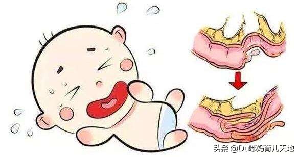 婴儿肠套叠的治疗方法有哪些,肠套叠怎么预防