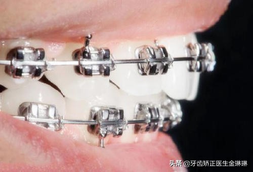 淄博矫正牙齿一般多少钱,淄博牙齿矫正一般多少钱
