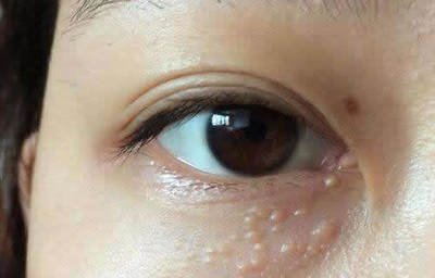 早上起来被自己眼睛吓到,眼周围的脂肪粒会自己消除