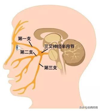 射频热凝治三叉神经痛的过程,三叉神经射频热凝术的费用是多少
