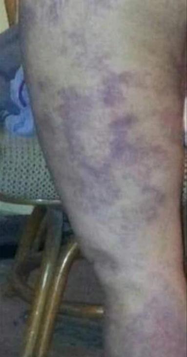 美国被殴打致死的女孩,华裔女子被丈夫殴打致死