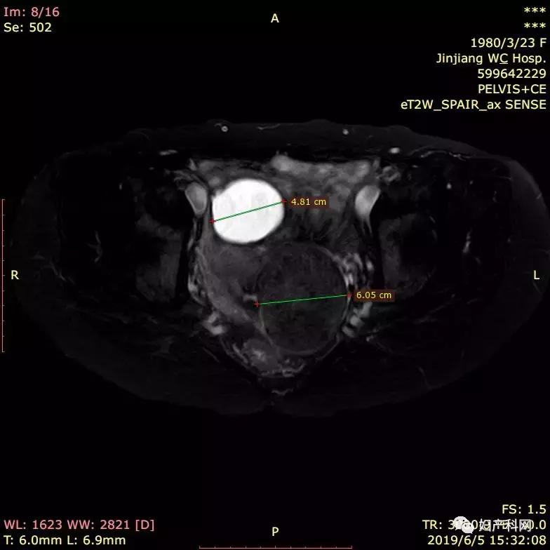 超声介入消融治疗卵巢囊肿,微无创治疗子宫肌瘤过程