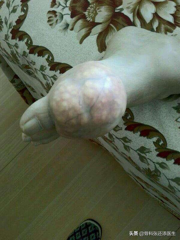 痛风能治愈？尿酸监测，药品选择，除了戒口，我们聊点深入的科普