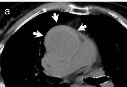 肠系膜上动脉夹层,心脏动脉夹层破裂