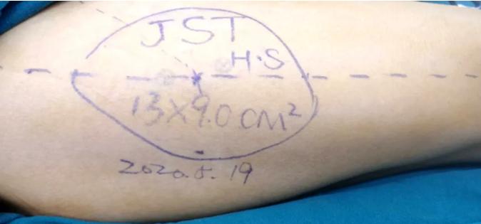 中年男子不慎撞伤左脚，手外科移花接木完美修复！