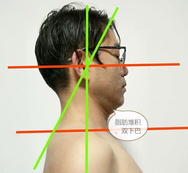 很瘦却有双下巴是什么原因,长得瘦却有双下巴