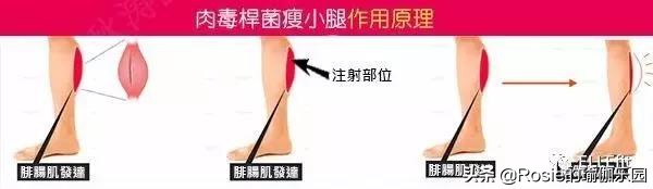 在腿上打瘦腿针20多针,瘦腿针多久能打第二针