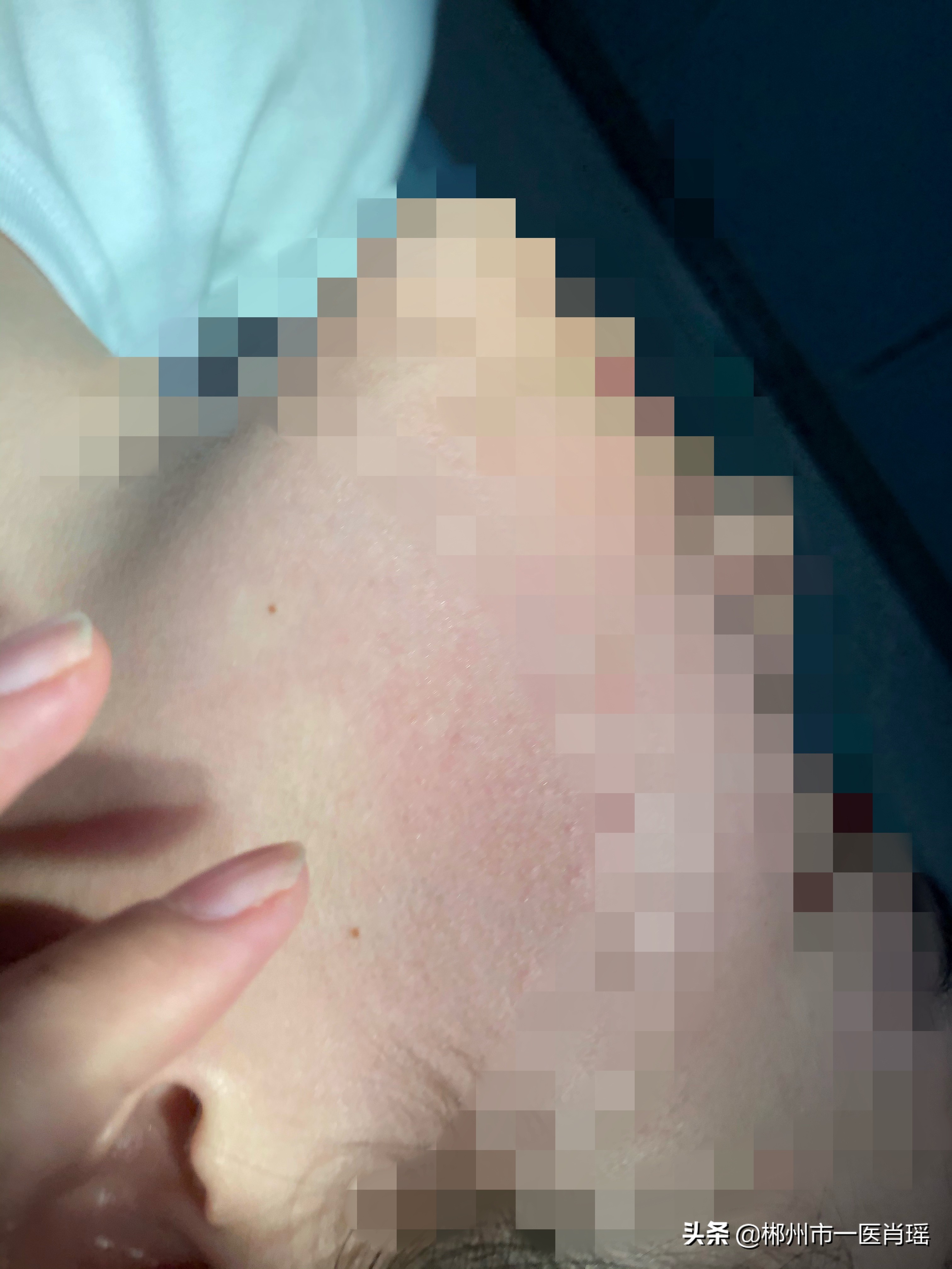 激光点痣留下的凹坑怎么修复,激光点痣会留疤有凹陷吗会好吗