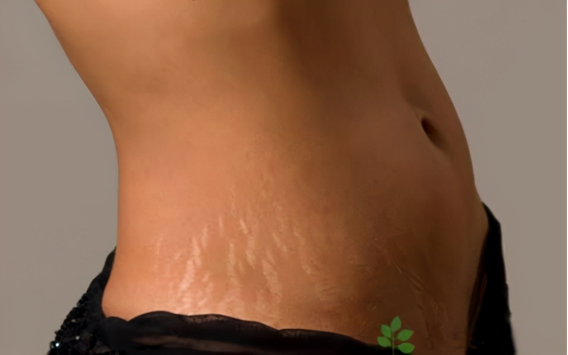 肥胖纹妊娠纹还有什么纹,肥胖纹或者生长纹怎么消除