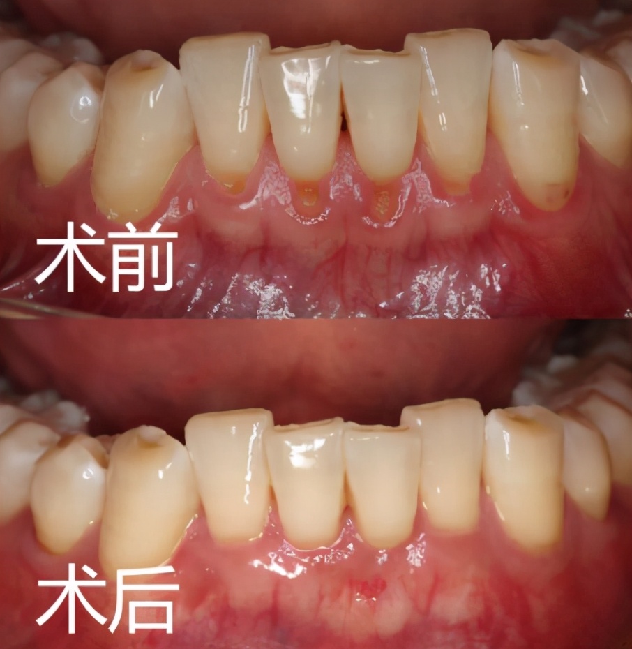 为什么牙龈会萎缩牙齿越来越小,牙龈为何萎缩如何补救