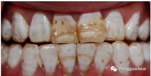 牙齿掉了镶哪种假牙比较好,牙齿缺失多用什么义齿好