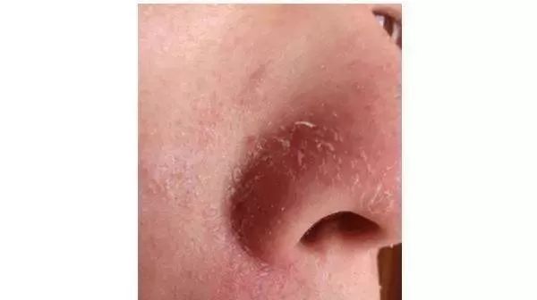 男士鼻子两侧干燥脱皮,秋冬季节鼻子旁边脱皮干燥怎么办