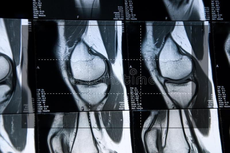 膝关节半月板损伤典型症状有哪些,膝关节半月板损伤是什么现象