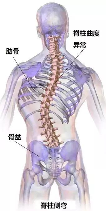 腰突脊柱侧弯最好的恢复方法,腰突为什么会引起侧弯