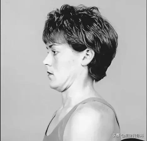 不花一分钱轻松治颈椎小学生,麦肯基颈椎治疗法真的有用