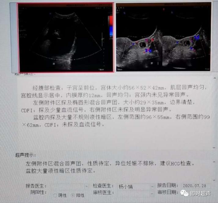 宫外孕的烦恼,你经历过宫外孕吗