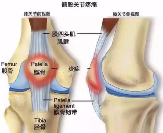 膝盖前面的韧带疼痛怎么回事,膝盖疼别担心一个有效方子可改善