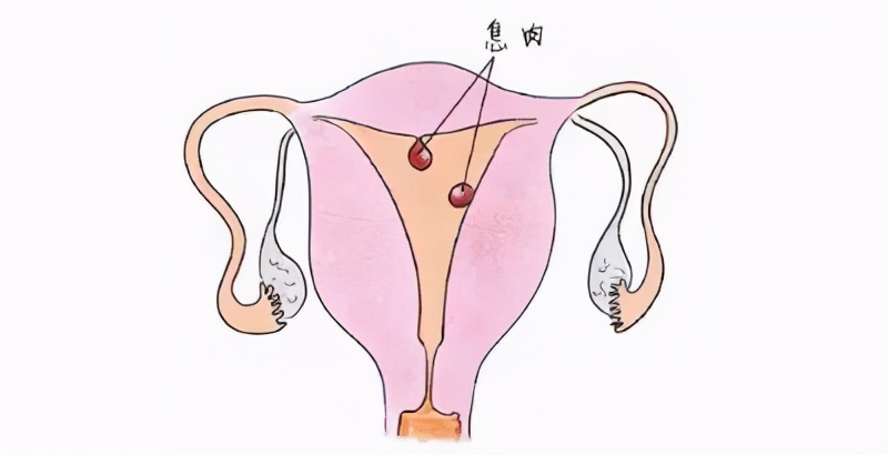 肌瘤和子宫内膜息肉都可以怀孕吗,多发性子宫内膜息肉可以怀孕吗