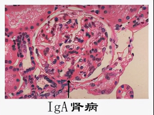 什么是肾穿刺,什么是肾穿刺检查