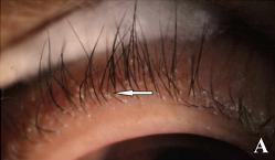 眼部螨虫,心灵窗户中不可忽视的隐秘角落,药师教您轻松预防治疗