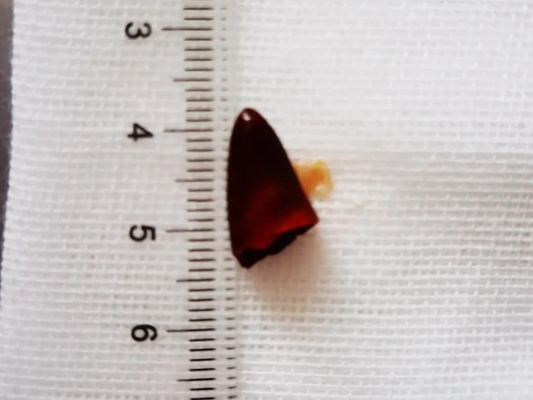 干辣椒引发肺腑之“炎”支气管镜冻取技术速灭“火”——记一次惊心动魄的支气管镜探查实录