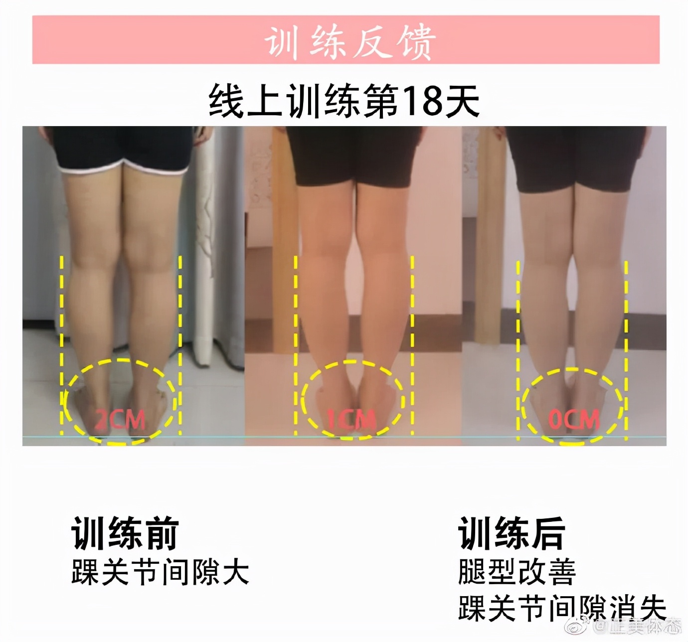 o型腿怎么走路有助于变直,成人o型腿最快变直的方法