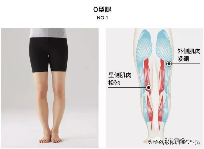 o型腿和罗圈腿图片对比,o型腿和罗圈腿的区别