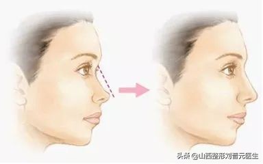 捏鼻子能让鼻梁变高,婴儿捏鼻梁变高真的吗