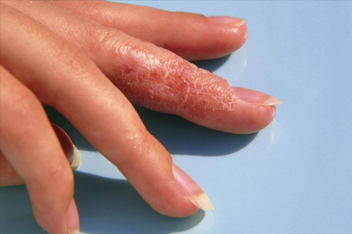 为什么湿疹反反复复这么顽固,为什么湿疹反反复复