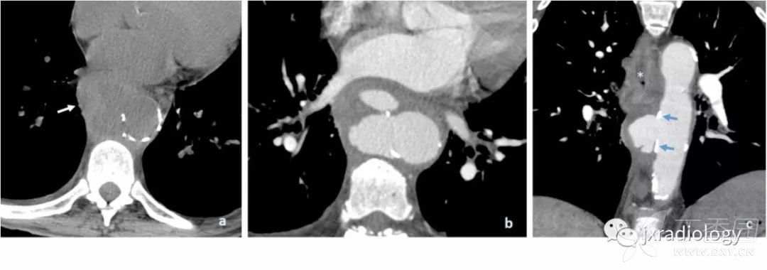 急性主动脉综合征报道,急性主动脉综合征症状