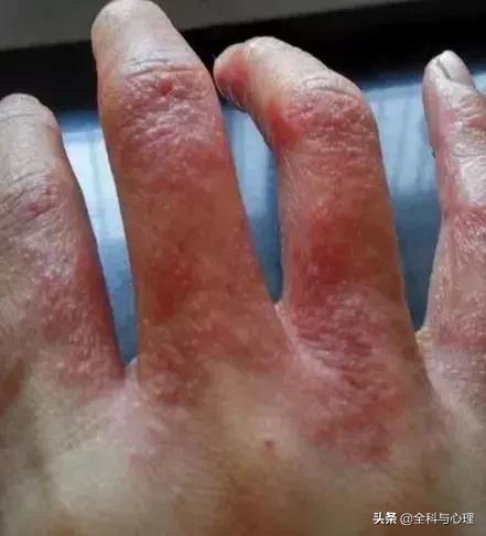 手臂腿上小水泡抓破很痒,手上脚上起小水泡很痒是怎么回事
