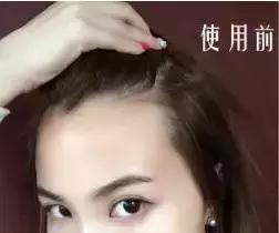 发际线后移的头发还能长出来么,头发发际线高还能长出来吗