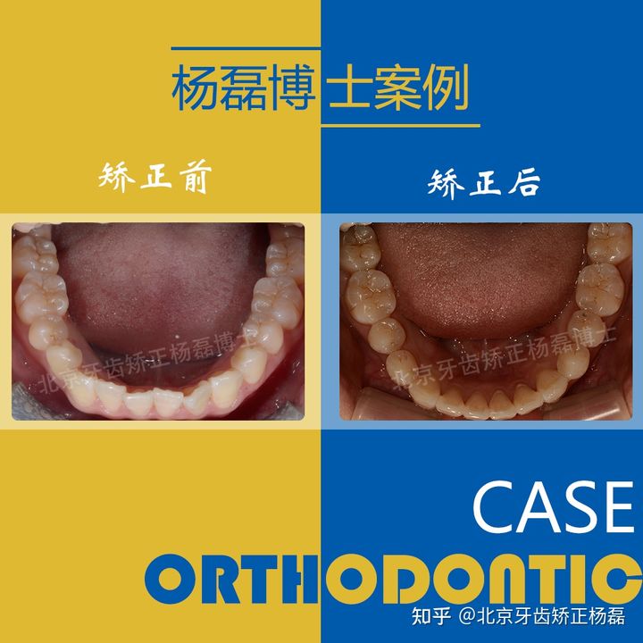 北京牙齿深覆合矫正推荐,重度拥挤牙齿矫正案例不拔牙