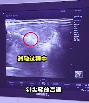 真实案例：警惕建筑材料中致病因素！患者3.9cm甲状腺结节已融合