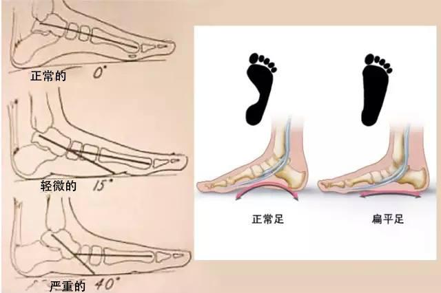 一只脚扁平足另外也会是扁平足吗,柔韧性扁平足和僵硬性扁平足区分