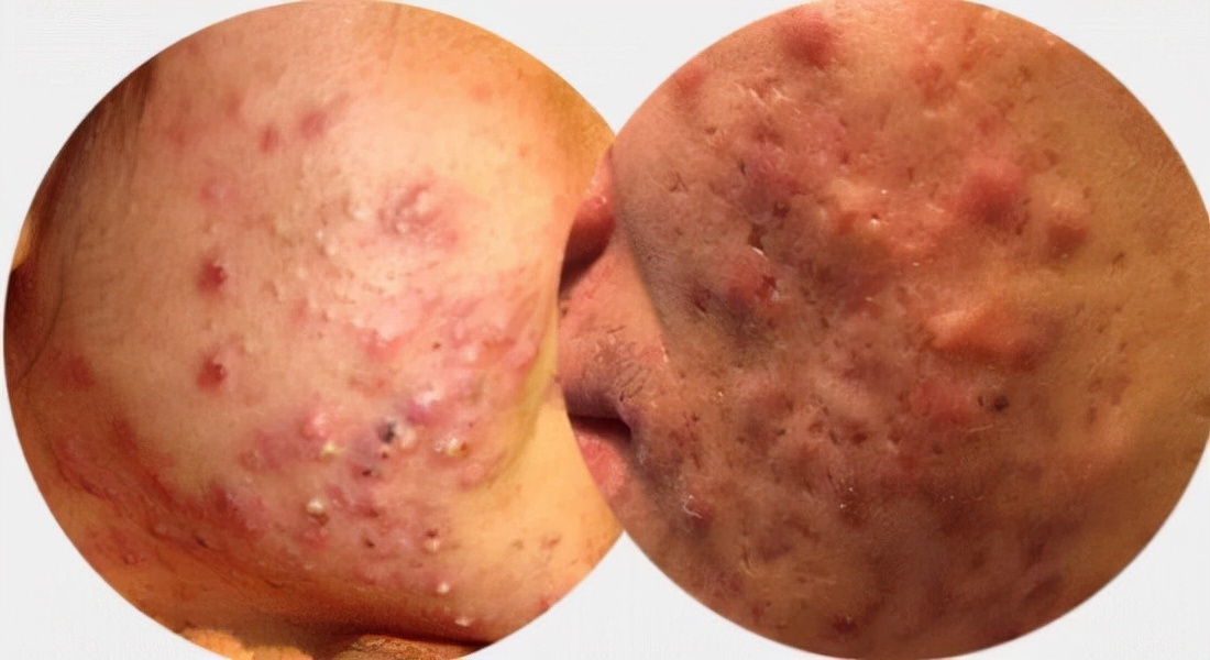 战痘的正确方法图解,五个“战痘”小妙招