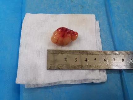 儿童90%为良性，成人却不到10%？患者气短3年，胸部CT提示的气管肿物意味着什么？气管镜有何发现？