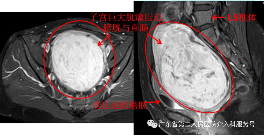 子宫肌瘤引起“大姨妈”排山倒海,淋沥不净……针眼妙方解除烦恼