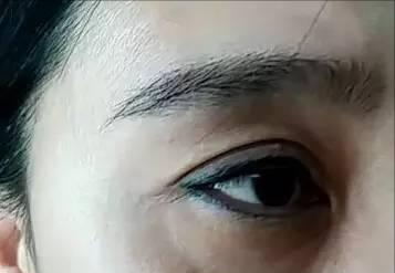 甲亢眼睛突真实案例,甲亢现状