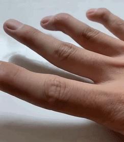 什么能促进手部肌腱断裂自愈,肌腱断裂保守治疗可以自愈吗