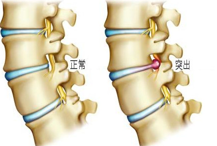 腿疼、腿麻、腰痛反复发作？那是因为没有找到治本的方法