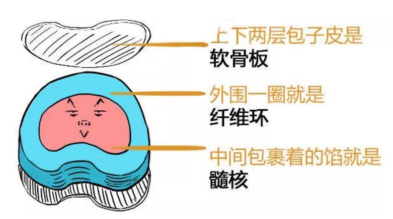 此文章让你彻底明白什么是:腰间盘突出