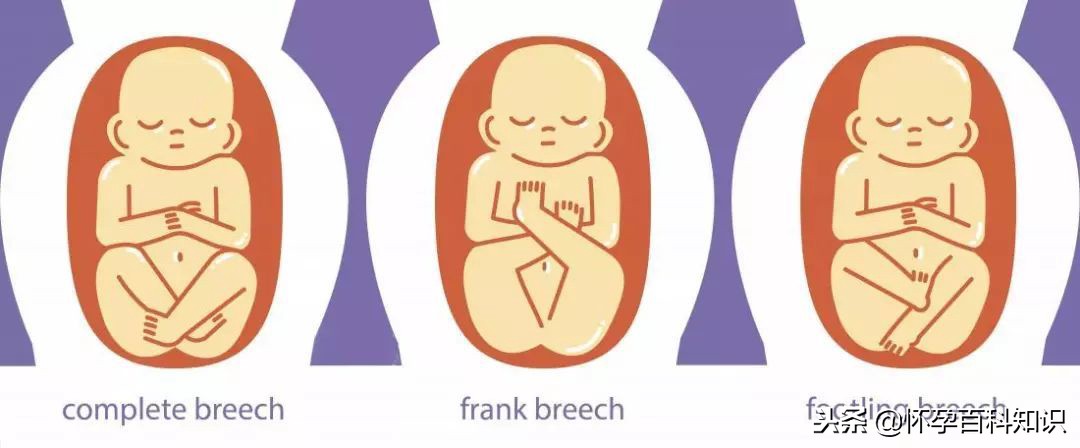 彩超loa代表胎儿的什么意思,彩超lof代表什么